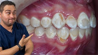 CARIES DENTAL POR BRACKETS ¡CUIDADO CON ESTAS MANCHAS BLANCAS SI TIENES ORTODONCIA [upl. by Llacam]