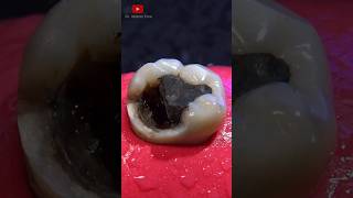 Indirect dental restoration satisfying [upl. by Acinnad409]