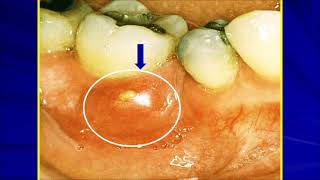 Spring 2021  Periodontics 2  Lec 1  Periodontal Abscess Part 1 [upl. by Ibmat]