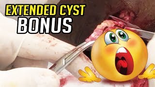 Extended Cyst Removal  Springtimes Bonus Video [upl. by Vivle]