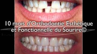 Dents écartées  diastème sur un adulte  correction avec 10 mois daligneurs® en OEFS© [upl. by Aeresed]