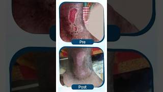 Live Varicose Veins Surgery 🩺 Start To End procedure shorts surgery veins shortsfeed [upl. by Bevash]