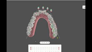 EXPANSION DentalMeshAIArchForm [upl. by Teddy]