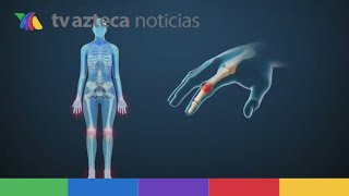 ¿Qué es la artritis reumatoide y cuáles son sus síntomas [upl. by Nitsej157]