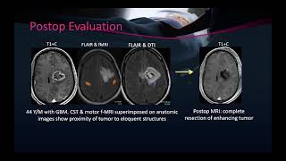 Imaging of High grade glioma [upl. by Ahsilaf]