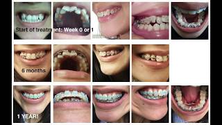 Adult braces timelapse 1 year [upl. by Adiahs988]