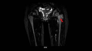 CAR  Case of the week  Case 12  Tubercular osteomyelitis [upl. by Byrd]