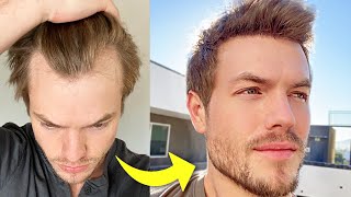 My Turkey Hair Transplant 4 Month Update  Before amp After [upl. by Audette]