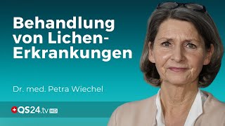 LichenErkrankungen Ist die Behandlung mit Cortisonsalbe genug  Dr med Petra Wiechel  QS24 [upl. by Melicent239]