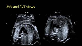 Fetal Echocardiography The 3VTV and identifying arch abnormalities [upl. by Aeikan956]