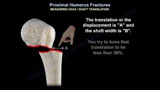 Proximal Humerus Fracture  Everything You Need To Know  Dr Nabil Ebraheim [upl. by Neillij478]