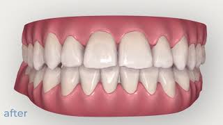 Invisalign Example 1 Moderate Crowding and Crossbite [upl. by Lamonica]