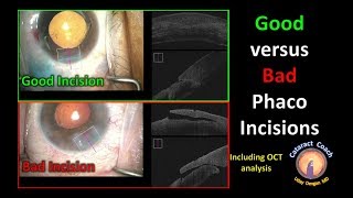 Good versus Bad Phaco Incisions for Cataract Surgery with OCT analysis [upl. by Eissert57]