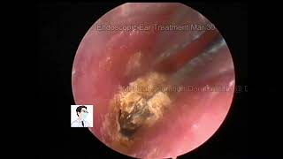 Ear wax removal Comparatively tenacious outer ear canal fungus20230330 [upl. by Ancier]