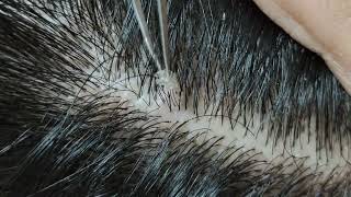 Relaxing dandruff removal w tweezers 15 02sleepyheads  visual ASMR oddlysatisfying [upl. by Erbes331]