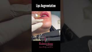 Lips filler  lips augmentation  lips enhancements before and after [upl. by Poucher]