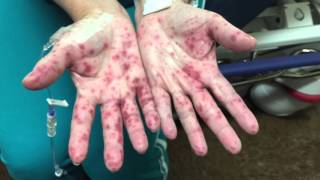 Palmar rash  differential diagnosis work up treatment [upl. by Allenrad]