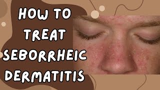 SEBORRHEIC DERMATITIS TREATMENT Get Rid of DANDRUFF NOWquot [upl. by Leahey299]