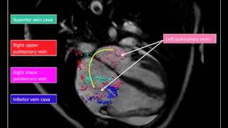 4D PhaseContrast Flow Cardiovascular Magnetic Resonance Comprehensive Quantification and Visualiz [upl. by Dragone]