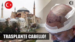 Trasplante Capilar en Turquía  Viaje todo incluido  Injerto capilar en Directo [upl. by Lrig]