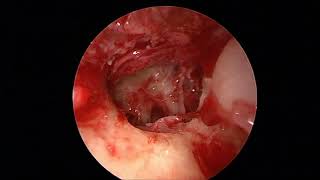 Endoscopic Transcanal Excision of Otic Capsule Schwannoma [upl. by Tallou]