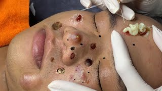 blackheads new 2023  popping pimple today  blackheads and whiteheads removal [upl. by Sedruol]