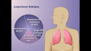 The Pathophysiology of Nonsmall Cell Lung Cancer [upl. by Tham908]