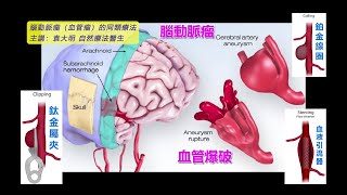 《自然療法與你》 EP707  腦動脈癅（血管瘤）的同類療法 [upl. by Oleg902]