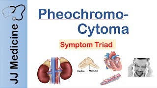 Pheochromocytoma  Symptoms and Treatment [upl. by Dnaleel]