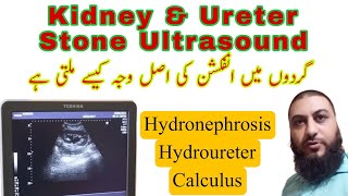 Kidney stone  ureter stone  Hydronephrosis  Hydroureter  Dr Qazi Fahim Shezad [upl. by Tjader]