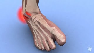 Mayo Clinic Minute Ankle sprains 101 [upl. by Roarke]