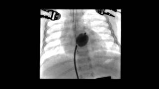 Balloon Atrial Septostomy Step 2 [upl. by Auqenahc96]