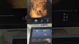 Penile Fracture  Grade 2  Ultrasound [upl. by Leahcam]