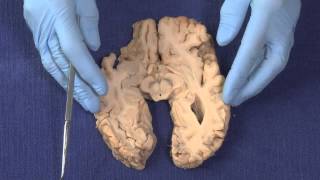 Basal Ganglia Neuroanatomy Video Lab  Brain Dissections [upl. by Wulfe738]