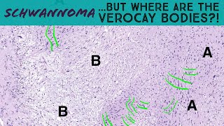 Where are the Verocay bodies Recognizing subtle nuclear palisading in schwannoma Pathology [upl. by Enitsua918]