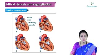 Mitral Stenosis amp Mitral Regurgitation Hindi  Internal Medicine🫀🫀🫀 [upl. by Bakeman929]