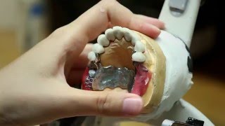 Prothèse clipsée sur dents Réalisation  Endurance Implant [upl. by Raji]