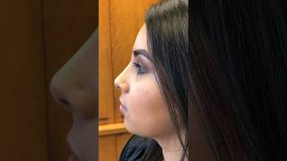 Closed Scarless Rhinoplasty No external cuts No external scars nosejob bestrhinoplastysurgeon [upl. by Fernandina419]