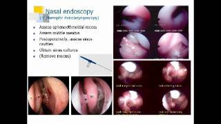 Sinusitis and Nasal Polyps Dan Hamilos MD [upl. by Ahsinyt]