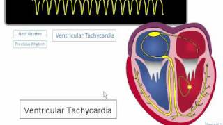 ECG Rhythm Review Ventricular Tachycardia Torsades de points Asystole [upl. by Wahkuna]