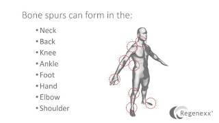 What is a Bone Spur [upl. by Reeva]