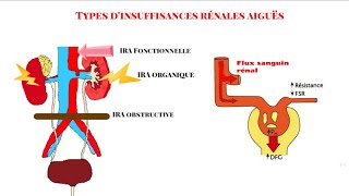 Physiopathologie et types dIRA [upl. by Lamberto]