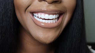 400 Veneers At Home VERY Affordable Smile Makeover  Shiny Smile Veneers Review  Dolce Mateo [upl. by Eeliak]