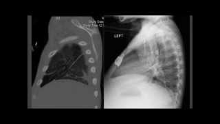 1 cm Pneumonia on PoCUS CXR negative CT positive [upl. by Franklyn]