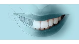 Porcelain Veneers Vs Composite Veneers [upl. by Schafer]