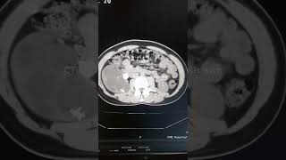 CT KUB Hydronephrosis Calculi CT KUB Pathology How to ct kub Kidney stone [upl. by Tower]