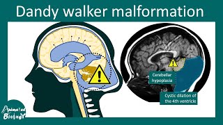 Dandy Walker Malformation  Diagnosis symptoms and treatment [upl. by Lahcsap]