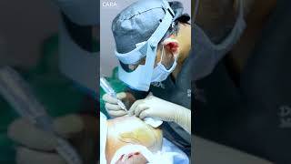 Viral Hair Transplant Surgery at Cara Clinic [upl. by Enoch805]