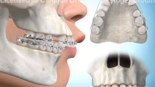 Extractions de dents pour correction surplomb horizontal [upl. by Schargel]