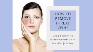 How to PERMANENTLY remove thread veins  Julie Scott Nurse Prescriber [upl. by Nosyd]